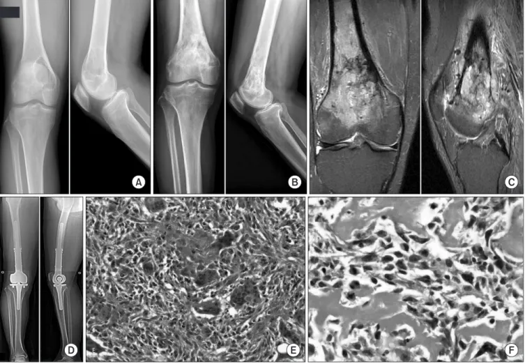 Figure 2. 31-year old man with secondary malignant giant cell tumor. (A) Initial plain radiograph shows osteolytic lesion at medial condyle of right  distal femur