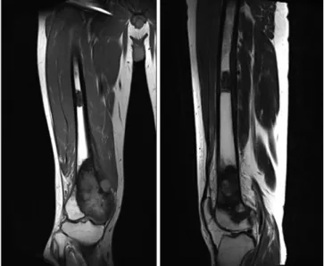 Figure 3. Whole body bone scan at presentation showing isolated area  of increased uptake in medial aspect of right distal femur