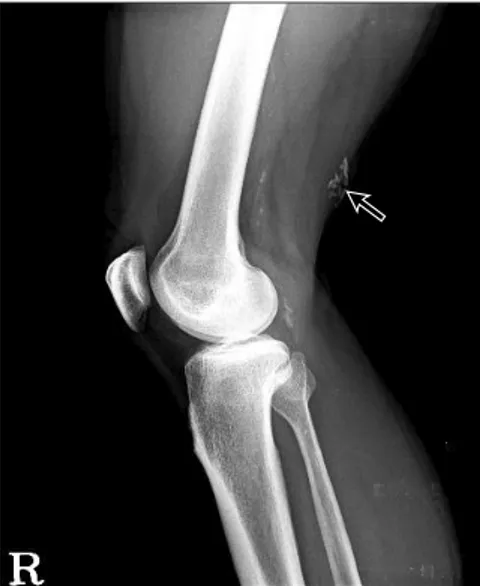 Figure 1. Lateral radiograph of right knee show calcified lesion (arrow)  on posterior area of distal femur.