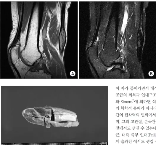 Figure  2.  Magnetic  resonance  images  shows well-defined soft tissue mass along  semitendinosus tendon, posterior aspect of  distal thigh