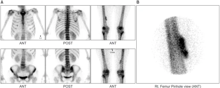 Figure  3.  Computed  tomography: Window  of  soft  parts  where  an  intramuscular expansive process can be seen around the femur, with  the radiodensity of fat