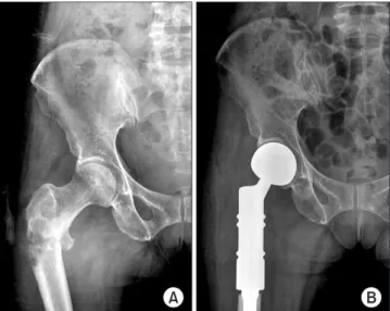 Figure 4. (A) Pre-operative radiograph of wide spreaded peritrochanteric  pathologic fracture of the left femur (arrow: tumor extent)