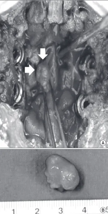 Figure  5.  (A)  Intraoperative  finding  shows  oval  shaped  mass  communicating with nerve root (arrow)
