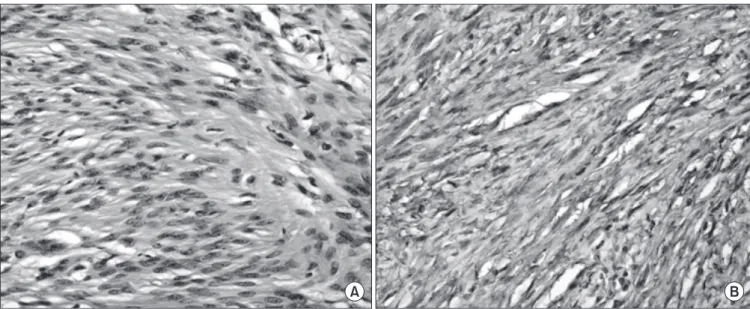 Figure 6. Microscopic histologic feature (×400) shows palisading pattern which is the specific finding of Schwannoma