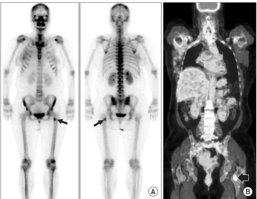 Figure 2. Radiograph in a 46-year-old woman shows an intramedullary  lesion with a diffuse sclerotic lesion (arrow) on left proximal femur.