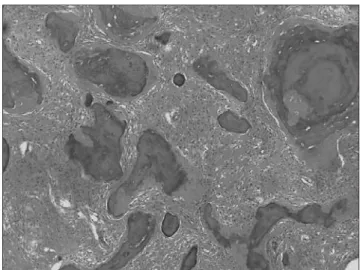 Figure 4. In microscopic examination, fibrous tissue blended into the  bone spicules, which had irregular shapes and imperceptible osteoblast  rimming (H&amp;E ×100).