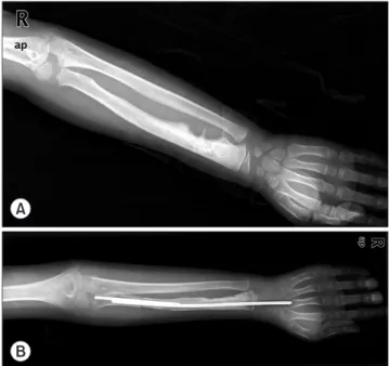 Figure 1. (A) Initial plain radiograph of 6-year-old patient (Case 1) shows  osteoblastic lesion with periosteal reaction on distal radius