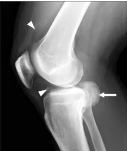 Figure 1. Lateral radiograph shows a soft tissue mass (arrow) containing  dense mineralization extending into the popliteal fossa