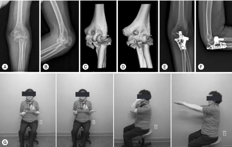 Fig. 1. A 66-year-old woman fell on the ground and injured her left elbow (Jupiter’s Type 2A fracture dislocation associated with a radial head  fracture and coronoid process fracture)
