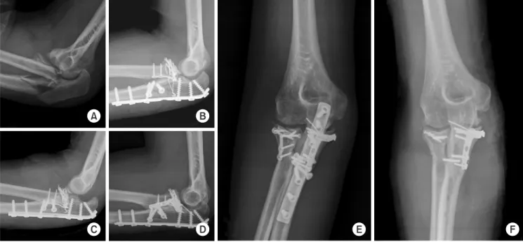 Fig. 3. A 22-year-old woman fell from a height and injured her right elbow (Jupiter’s Type 2D fracture dislocation associated with the radial head  fracture and coronoid process fracture)