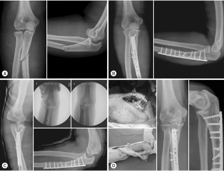 Fig. 4. A 40-year-old man injured by a motor cycle traffic accident and injured his right elbow (Jupiter’s Type 2C fracture dislocation associated  with lateral ulnar collateral ligament rupture)