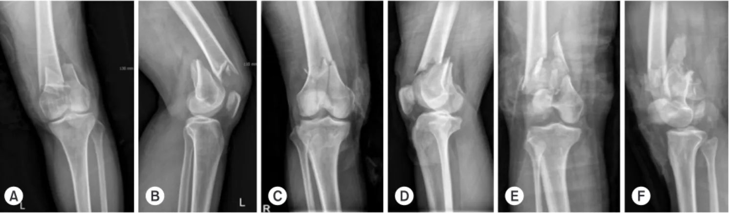 Fig. 1. Simple radiographs show anterior-posterior and lateral view of distal femur fractures: AO/OTA classification
