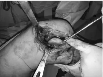 Fig. 2. Intraoperative photograph showing the lateral parapatella ap- ap-proach for articular exposure and reconstruction.