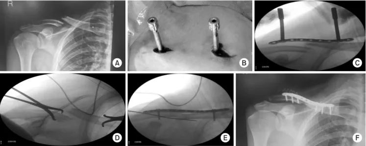 Fig. 1. (A) Preoperative radiography. (B) Plate was slid through the submuscular tunnel