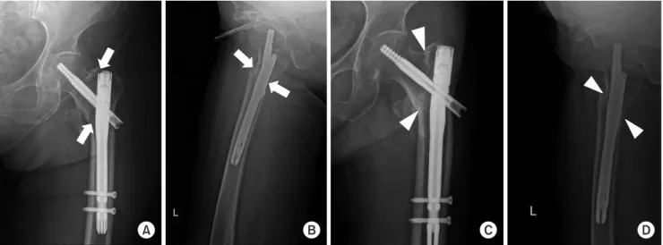 Fig. 1. (A) Hip antero-posterior (AP) view of left intertrochanteric fracture immediately postoperation