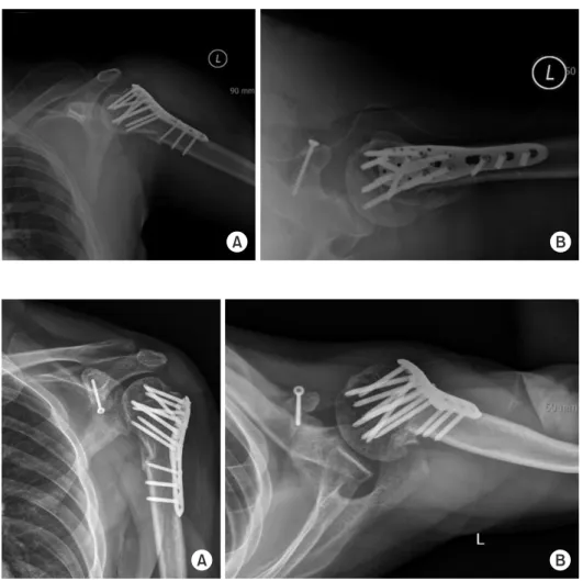 Fig. 4. Immediate postoperative plain  radiographs anteroposterior (A), axial (B)  view were assessed.