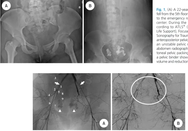 Fig. 2. (A) Transarterial pelvic aortography demonstrated diffuse attenuation of bilateral common, external (arrows), and internal iliac arteries
