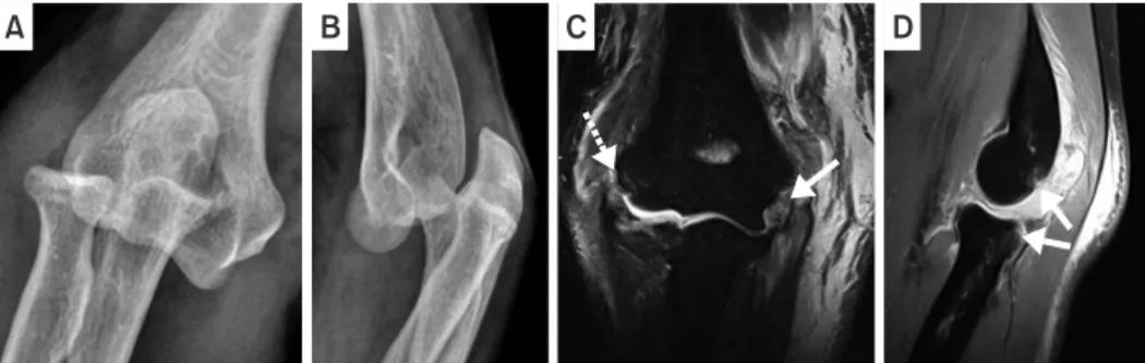 Fig. 1. (A, B) Simple anteroposterior and lateral radiographs of posterolateral dislocation of the elbow joint