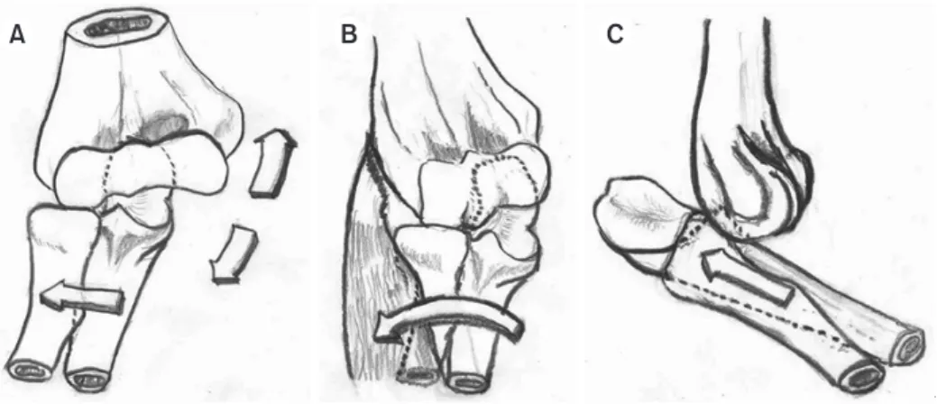 Fig. 3. Sequential scenario of the most common posterolateral dislocation of the elbow joint