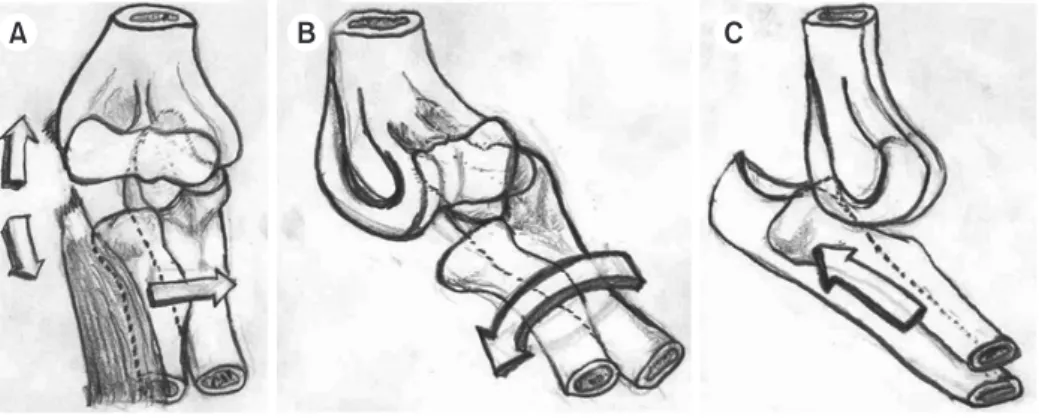 Fig. 4. Sequential scenario of the rare posteromedial dislocation of the elbow joint. (A) The axial force applied along the forearm during the initial  injury converts to a varus force at the lateral side, which is rare due to the common cubitus valgus cha