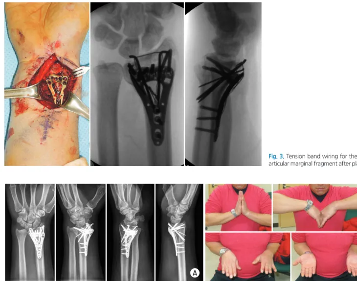 Fig. 3. Tension band wiring for the volar  articular marginal fragment after plating.