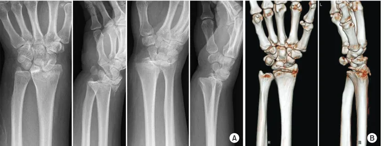 Fig. 5. (A) The simple volar articular marginal fragment of the distal radius on plain radiography