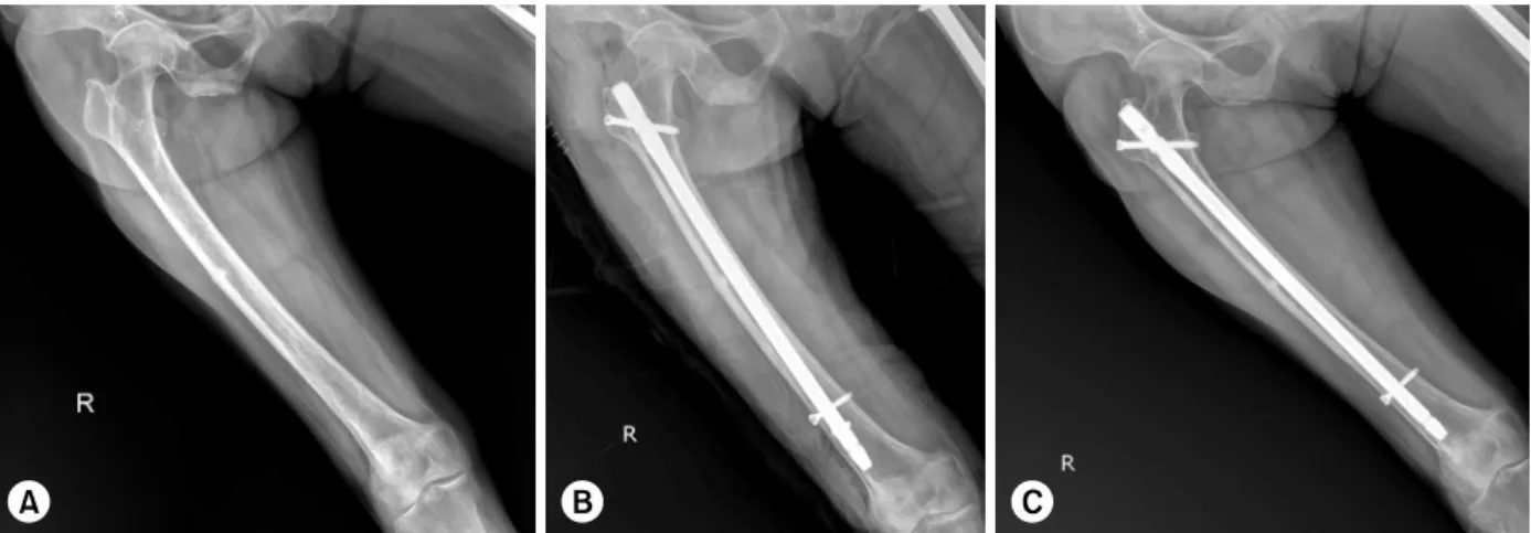 Table 3. Comparison of Prophylactic Fixation and Postfracture  Fixation 