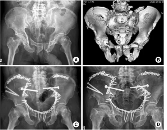 Fig. 1. A 69-year-old man’s (A) initial pelvis  anteropo-sterior view and (B)  pelvis  computed tomography image  showed the AO/OTA type C3  pelvis fracture