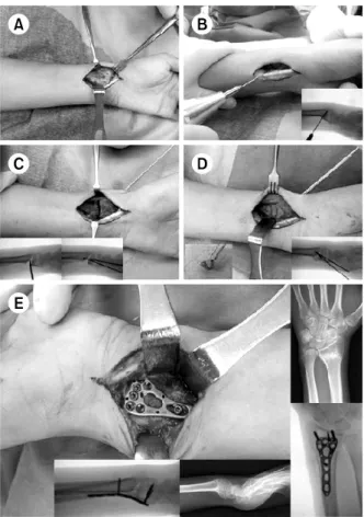 Fig. 1. Intraoperative photographs show surgical approach  (A), wedge osteotomy and wedge shaped iliac bone (B, C,  D), and plate fixation (E).