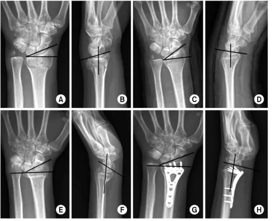 Fig. 3.  (A, B) Initial simple  radiographs show Colles’  fra-cture with ulnar styloid  frac-ture