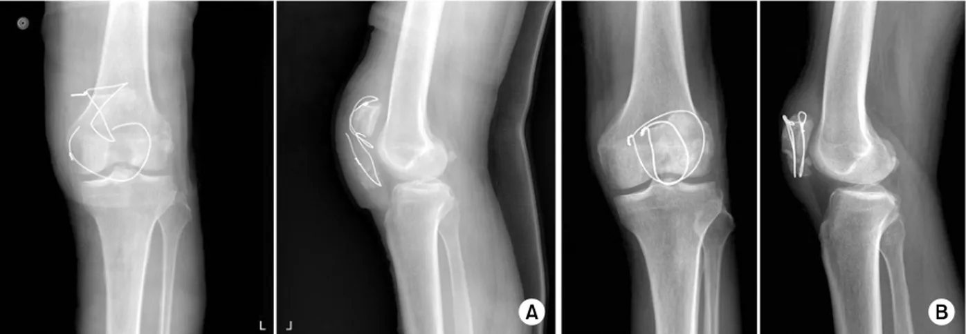 Fig. 3. (A) Anteroposterior and lateral plain radiographs showing a broken wire, two months after the operation