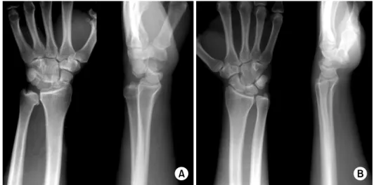 Fig. 1. (A) Plain radiographs  at initial trauma show the  transscaphoidal dorsal perilunar  dislocation associated with  di-slocation of distal radioulnar  joint