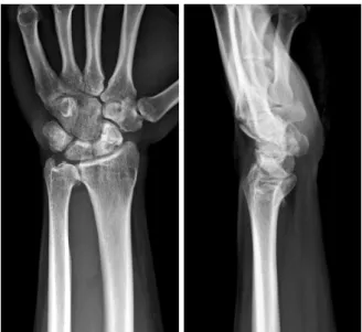 Fig. 4. Radiographs at 15 months after surgery show bony  unions without carpal instability.