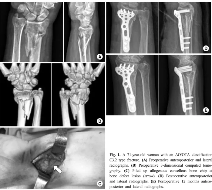 Fig. 1. A 71-year-old woman with an AO/OTA classification  C3.2 type fracture. (A) Preoperative anteroposterior and lateral  radiographs