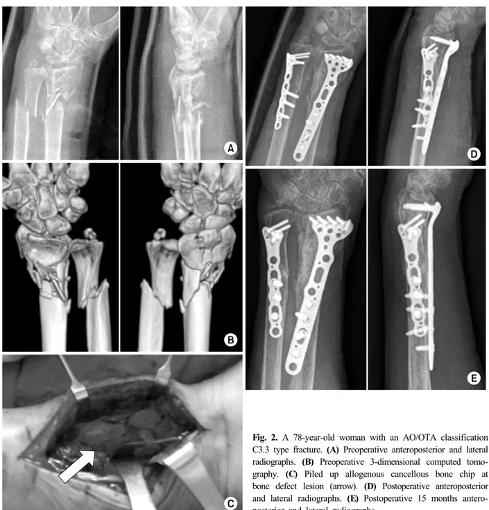 Fig. 2. A 78-year-old woman with an AO/OTA classification  C3.3 type fracture. (A) Preoperative anteroposterior and lateral  radiographs