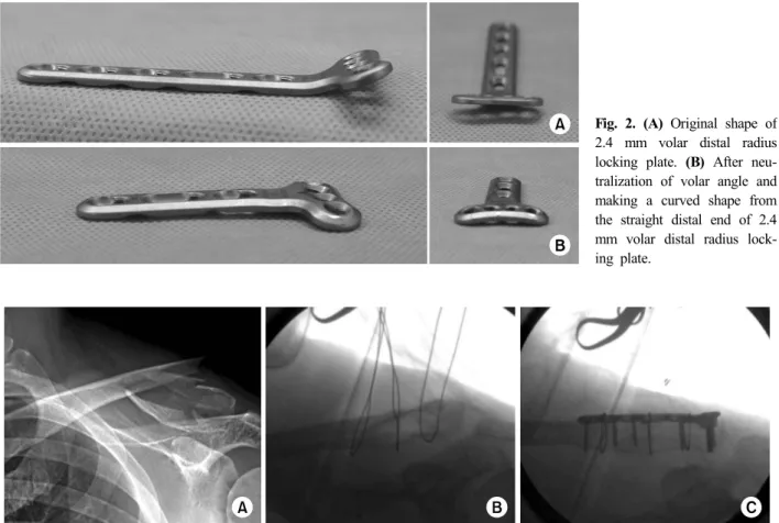 Fig. 2.  (A) Original shape of  2.4 mm volar distal radius  locking plate. (B) After  neu-tralization of volar angle and  making a curved shape from  the straight distal end of 2.4  mm volar distal radius  lock-ing plate.