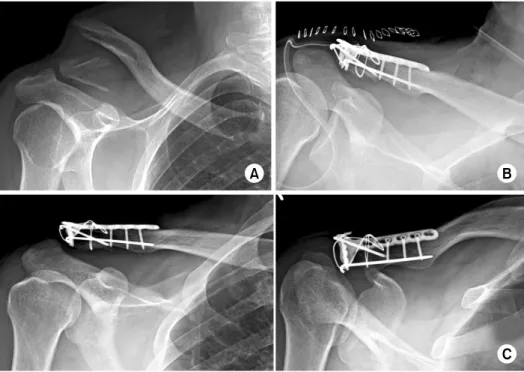 Fig. 4.  (A) Preoperative  clavicle anteroposterior (AP)  view of a 46-year-old male  shows a Neer V unstable  distal clavicle fracture