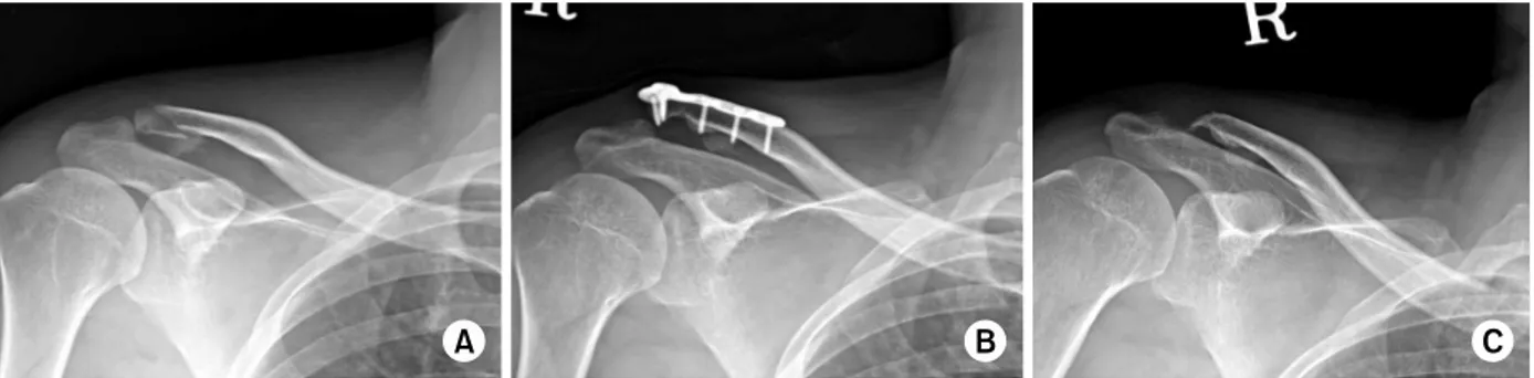 Fig. 6.  (A) Preoperative radiograph of a 42-year-old male shows a Near V unstable distal clavicle fracture
