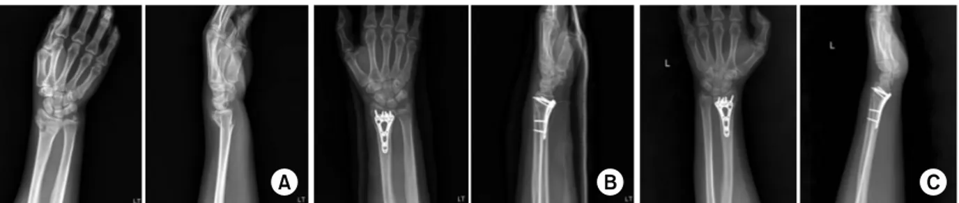 Fig. 1.  (A) A 40-year-old female patient presented with a distal radius fracture as AO classification C2