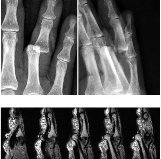 Fig. 1. Radiographs showed  the dorsoulnar dislocation of  the proximal interphalangeal  joint.