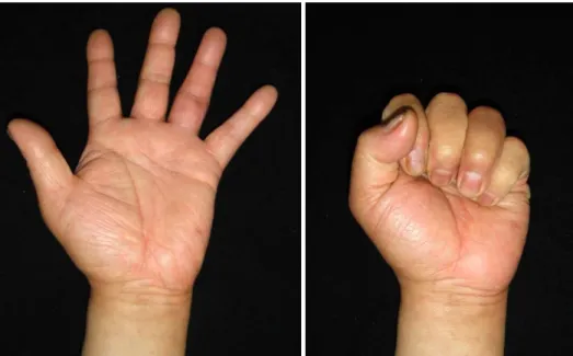 Fig. 5. At six months after  the operation, there was mild  swelling at the proximal  in-terphalangeal joint