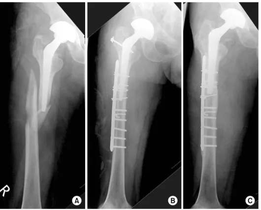 Fig. 1. A 46-year-old male pa- pa-tient with a Vancouver type B1 periprosthetic fracture treated  with open reduction and  in-ternal fixation dynamic  com-pression plate and screws