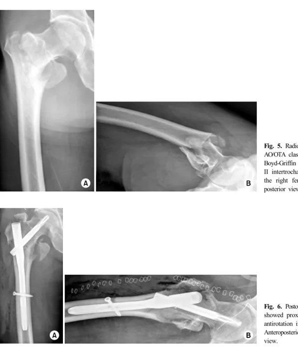 Fig. 5. Radiographs showed an AO/OTA classification 31-A2.1, Boyd-Griffin classification type II intertrochanteric fracture of  the right femur