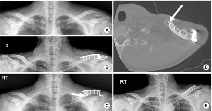 Fig. 1. (A) Neer type IIa distal clavicle fracture. (B) Open reduction and internal fixation with clavicular hook plate