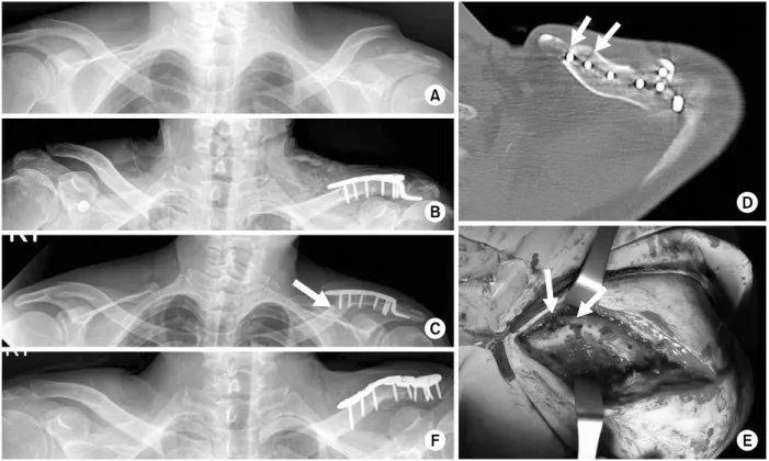 Fig. 3. (A) Neer type IIb distal clavicle fracture. (B) Open reduction and internal fixation with clavicular hook plate