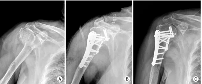 Fig. 1. (A) Preoperative anteroposterior radiograph suggested 3 part humerus surgical neck fracture according to Neer classifi- classifi-cation