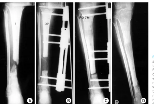 Table 1. Treatment of Wide Gap Non-Unions of the Lower Legs