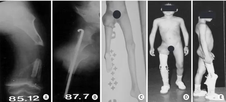 Fig. 6. (A) A 7-year-old boy had suffered from an uncontrollable osteomyelitis of the femur, with a 14 cm wide segmental defect, despite 6 at- at-tempts of sauscerization and 2 atat-tempts of vascularized fibular graft