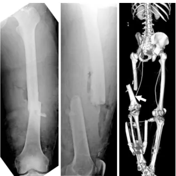 Fig. 1. A 33-year-old male suffered from open femoral shaft fracture  associated with complete femoral artery (arrow).