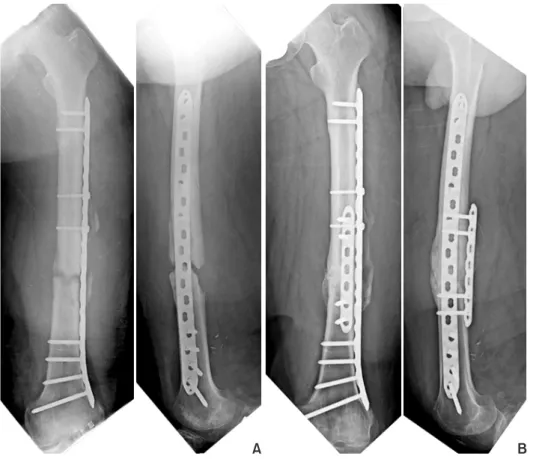 Fig. 3. (A) Plain X-ray taken 6 months  after the injury shows delayed healing of  the fracture without implant loosening